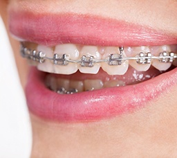 Close up of mouth with braces