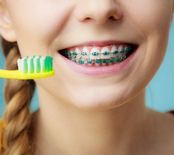 Close up of smiling girl with braces holding a toothbrush