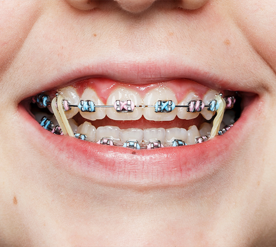 Close up of a smile with rubber bands on their braces