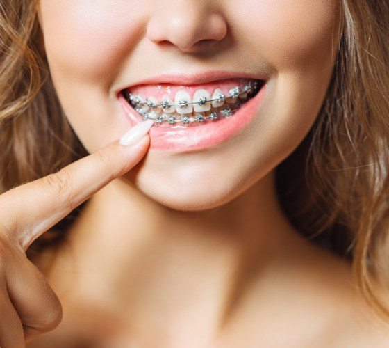 Young woman pointing to her braces