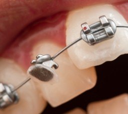 Close up of a braces bracket that has detached from a tooth