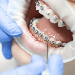 Up-close view of orthodontic checkup