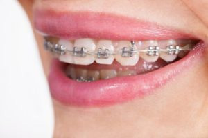 How to fix a loose wire from braces (Orthodontic emergency) 