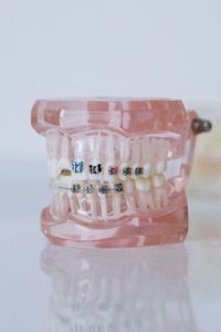 Metal braces on dental mold
