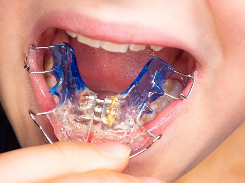 up-close view of a retainer